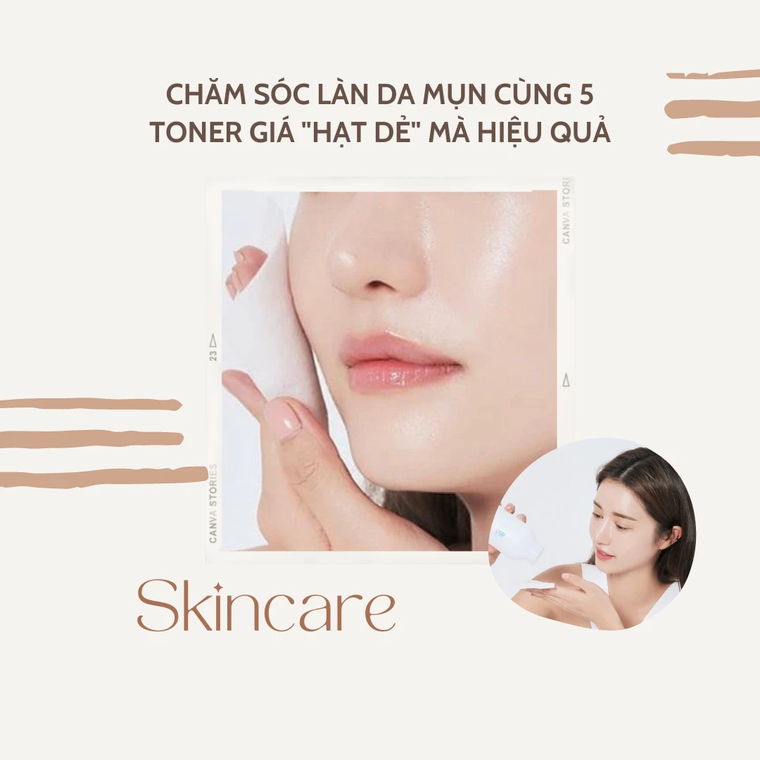 Chăm sóc làn da mụn cùng 5 toner giá "hạt dẻ" mà hiệu quả không ngờ