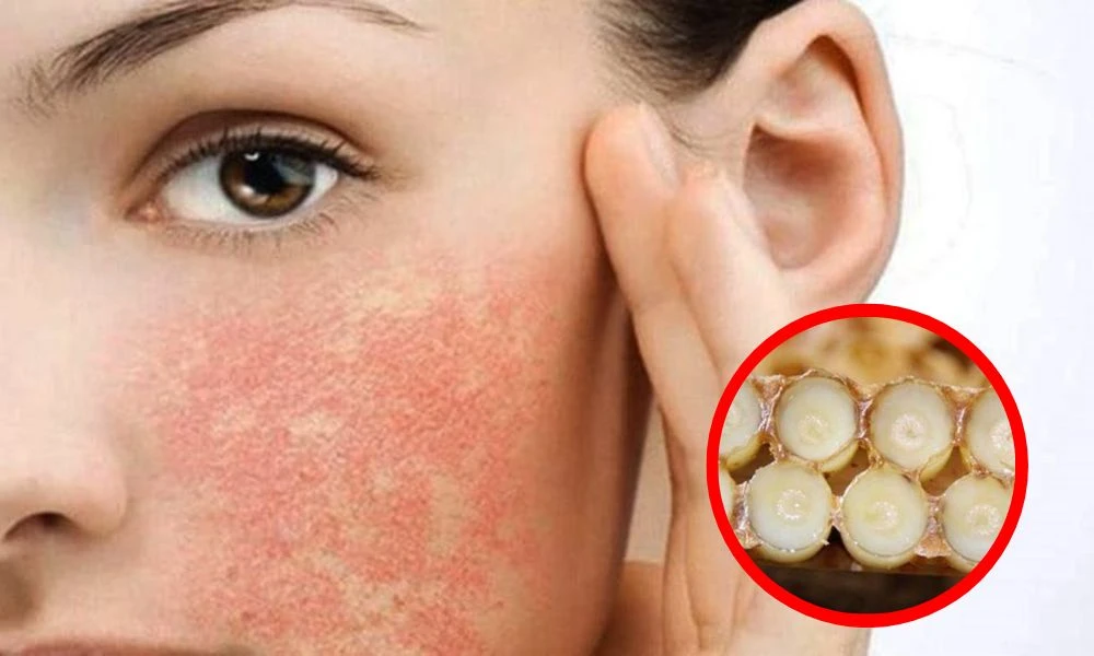 Những người không nên sử dụng sữa ong chúa Những người không nên sử dụng sữa ong chúa